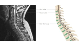 Rỗng tủy sống: Bệnh lý thần kinh hiếm gặp 1