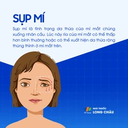 Sụp mí 1