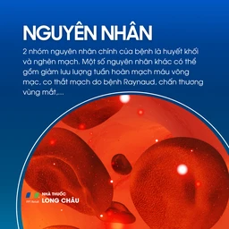 Tắc động mạch võng mạc trung tâm 3