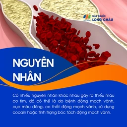 Thiếu máu cơ tim 3