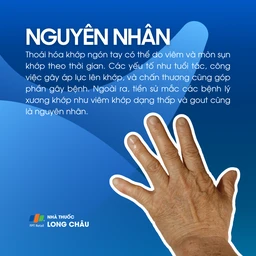 Thoái hóa khớp ngón tay 3