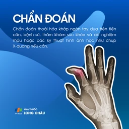 Thoái hóa khớp ngón tay 5