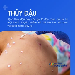 Bệnh thủy đậu là một bệnh truyền nhiễm do virus Varicella zoster gây ra, rất dễ lây