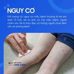 Trẻ em dưới 10 tuổi là đối tượng dễ mắc bệnh thủy đậu nhất