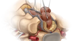 U tủy sống là gì? Nguyên nhân, triệu chứng và cách điều trị 1