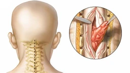 U tủy sống là gì? Nguyên nhân, triệu chứng và cách điều trị 2