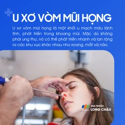 U xơ vòm mũi họng 1