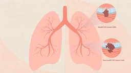 Ung thư phổi không tế bào nhỏ giai đoạn II: Hiểu rõ để điều trị tốt hơn 1