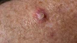 Ung thư tế bào vảy là gì? Triệu chứng, nguyên nhân, chẩn đoán và điều trị bệnh 1