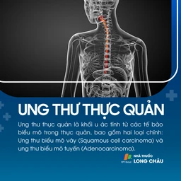 Ung thư thực quản 1