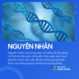 Vẹo cột sống 3