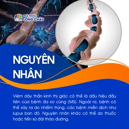Viêm dây thần kinh thị giác 3