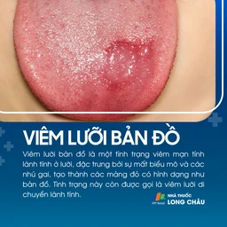 Viêm lưỡi bản đồ 1