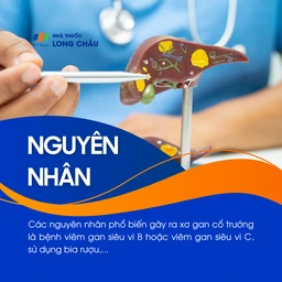Xơ gan cổ trướng 3