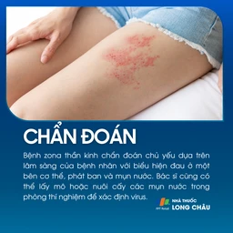 Chẩn đoán bệnh zona thần kinh qua biểu hiện phát ban