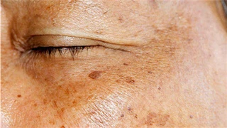 Đồi mồi: Nguyên nhân, triệu chứng và cách điều trị