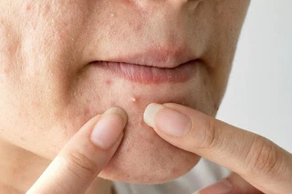 Mụn ẩn: Triệu chứng, nguyên nhân và cách điều trị