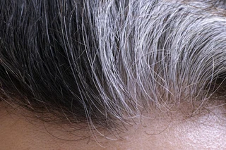 Vì sao tóc bạc sớm? Nguyên nhân, điều trị và cách phòng ngừa