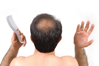 Hói - Nguyên nhân, điều trị và phòng ngừa