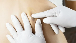 Bướu bã đậu là gì? Triệu chứng, nguyên nhân, chẩn đoán và điều trị bệnh