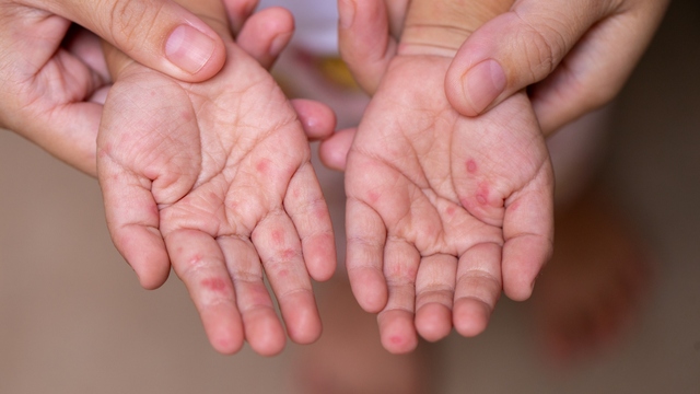 bai-viet/benh-tay-chan-mieng-khi-nao-het-lay-thoi-diem-lay-benh-nang-nhat.html