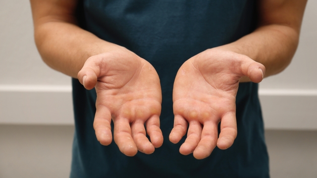 bai-viet/chai-tay-la-gi-nguyen-nhan-va-nhung-bien-phap-cai-thien.html