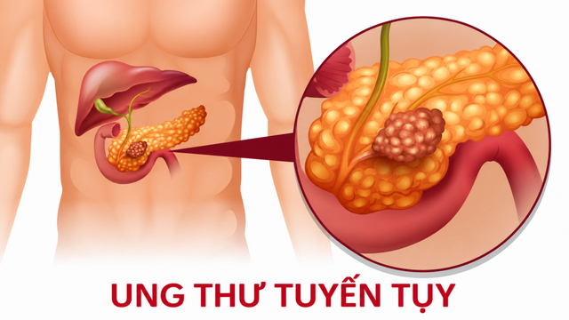 bai-viet/3-dau-hieu-ung-thu-tuyen-tuy-nhieu-nguoi-viet-chi-nghi-la-roi-loan-tieu-hoa-binh-thuong.html