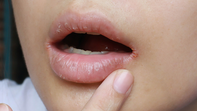 bai-viet/6-dau-hieu-thieu-chat-o-mieng-canh-bao-suc-khoe.html