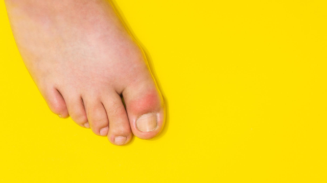 bai-viet/benh-gut-co-uong-duoc-nuoc-dua-khong-cach-dung-nuoc-dua-dung-cach-cho-nguoi-bi-gut.html