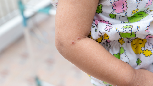 bai-viet/bi-chan-tay-mieng-kieng-gi-de-tre-nhanh-hoi-phuc.html