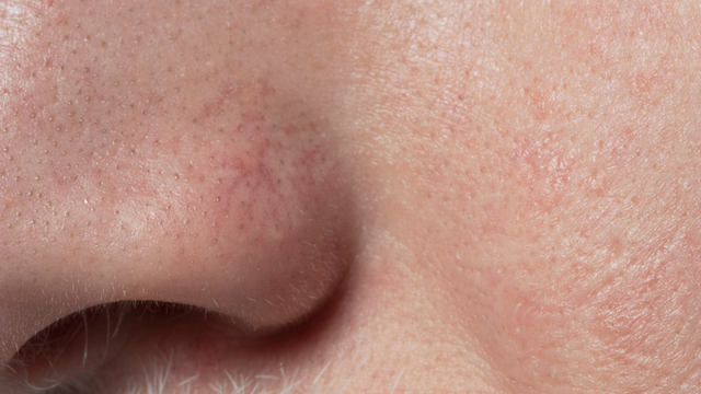 bai-viet/chuyen-gia-chi-ra-co-toi-4-loai-lo-chan-long-to-va-cach-khac-phuc-hieu-qua.html