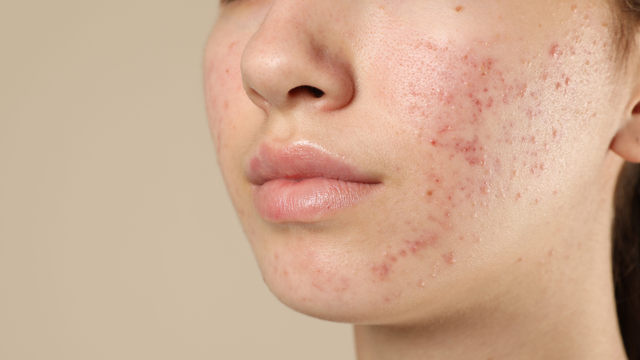 bai-viet/da-dau-mun-nen-rua-mat-may-lan-1-ngay-tot-nhat.html