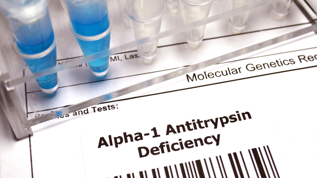 bai-viet/giai-dap-chi-tiet-ai-nen-xet-nghiem-alpha-1-antitrypsin-aat.html