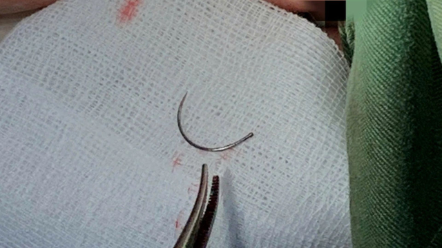 bai-viet/lay-di-vat-kim-khau-trong-tang-sinh-mon-cua-nu-benh-nhan-sau-11-nam-10009.html