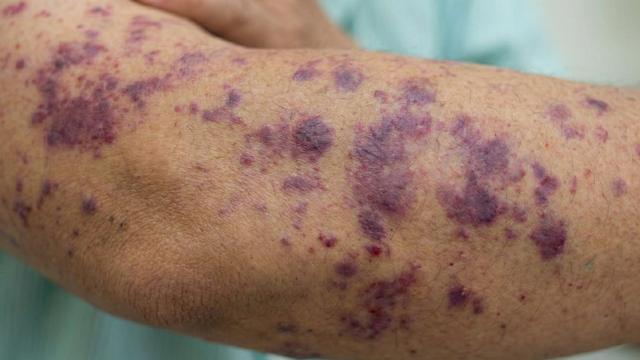 bai-viet/nao-mo-cau-gia-tang-de-nham-cum-tu-vong-nhanh-trong-24-den-48-gio.html