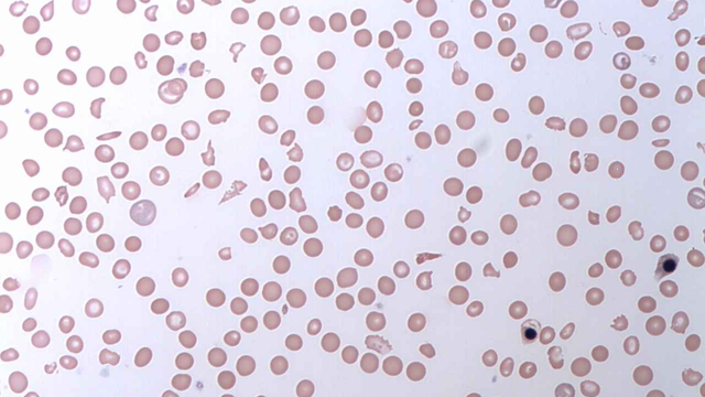 bai-viet/soliris-co-tac-dung-nhu-the-nao-doi-voi-benh-pnh-hieu-qua-dieu-tri.html