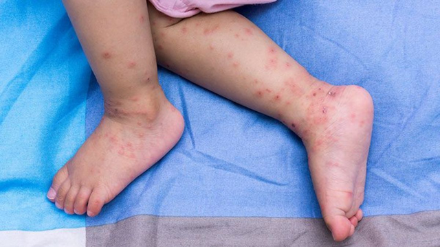 bai-viet/tre-bi-tay-chan-mieng-co-nen-boi-xanh-methylen-khong.html