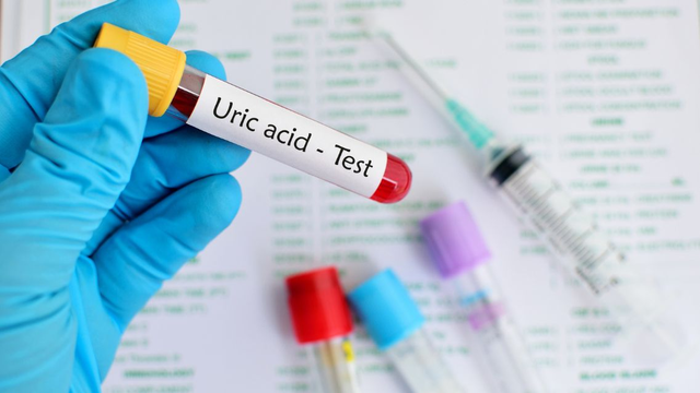 bai-viet/xet-nghiem-acid-uric-mau-la-gi-y-nghia-quy-trinh-va-gia.html