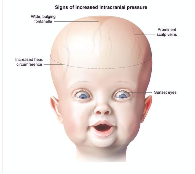 benh/hoi-chung-tang-ap-luc-noi-so-1005.html