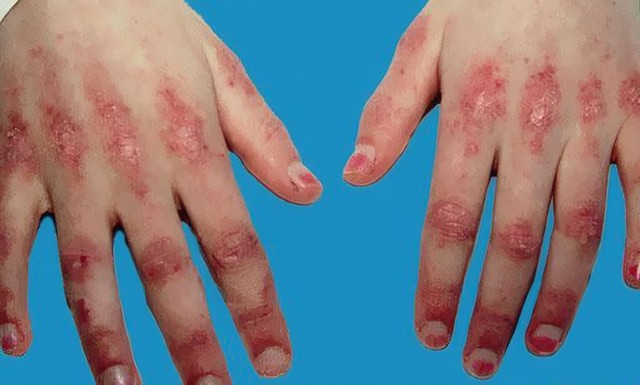 benh/viem-co-1176.html