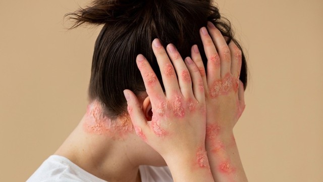 bai-viet/12-nguyen-nhan-bi-vay-nen.html