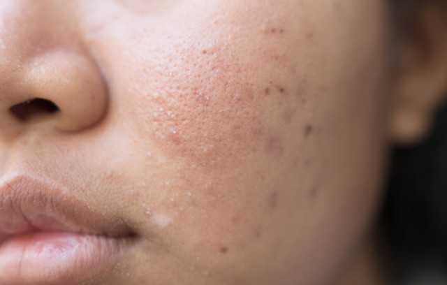 benh/mun-dau-den-1356.html