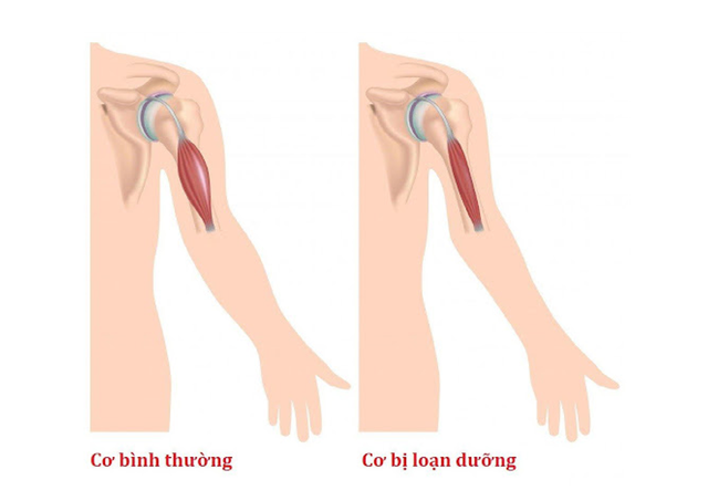 benh/loan-duong-co-19.html