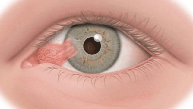 bai-viet/mong-thit-o-mat-va-cach-dieu-tri-benh-an-toan-hieu-qua.html