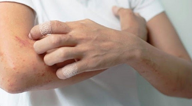 benh/viem-da-co-218.html