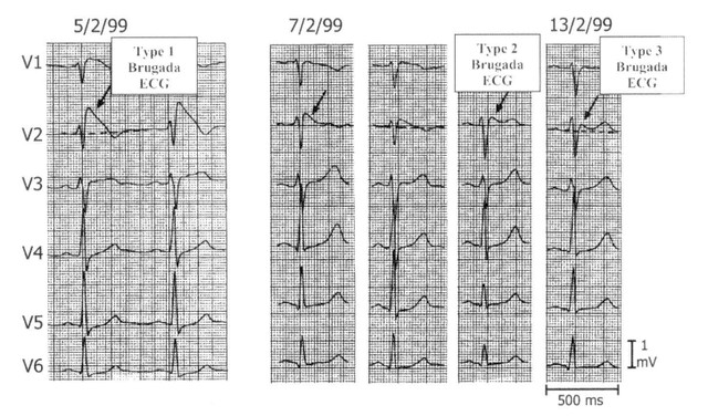 benh/hoi-chung-brugada-236.html