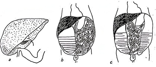 benh/tac-ruot-so-sinh-245.html