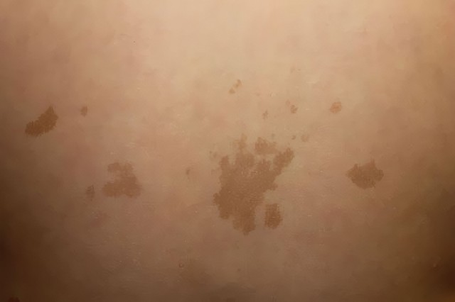 benh/u-soi-than-kinh-286.html