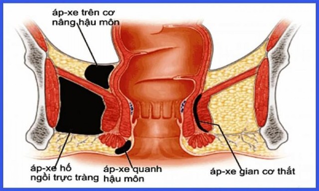benh/ap-xe-vung-hau-mon-truc-trang-2.html