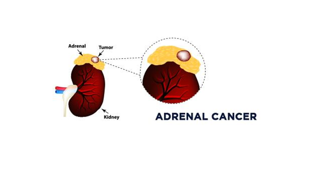benh/ung-thu-tuyen-thuong-than-323.html
